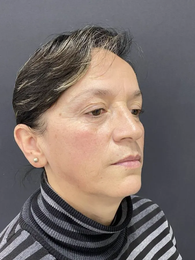 Antes de blefaroplastia y lipoinyección facial, caso 1, vista diagonal