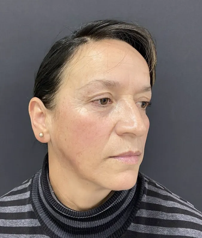 Después de blefaroplastia y lipoinyección facial, caso 1, vista diagonal