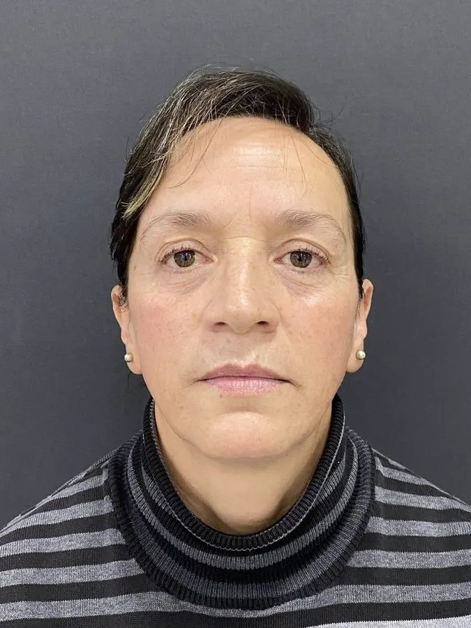 Antes de blefaroplastia y lipoinyección facial, caso 1, vista frontal