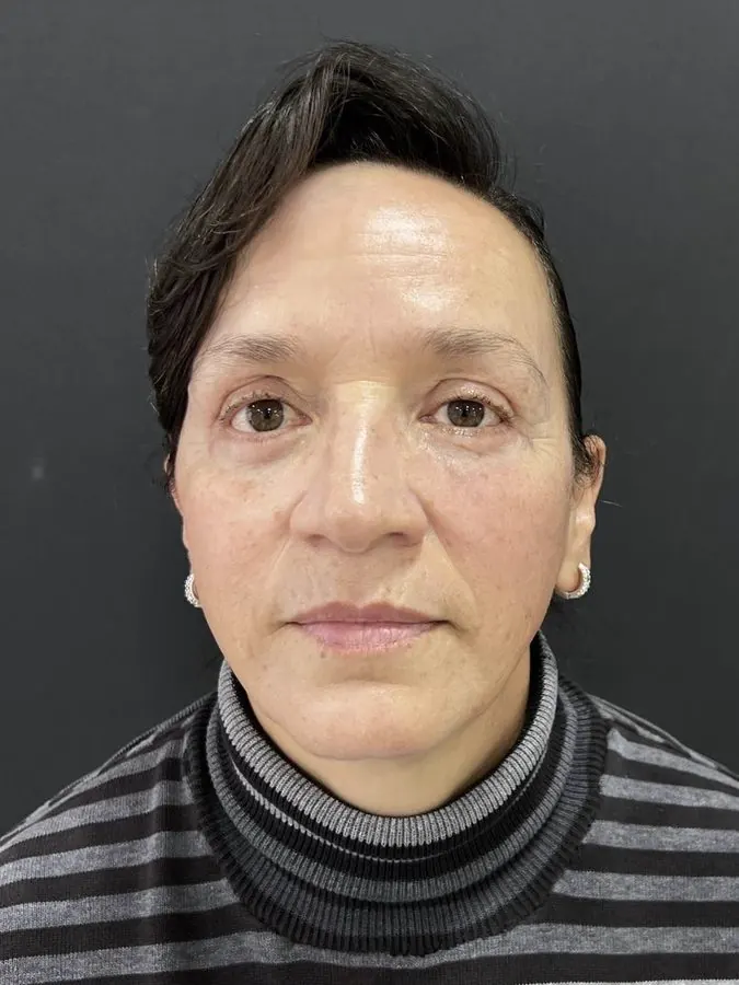 Después de blefaroplastia y lipoinyección facial, caso 1, vista frontal