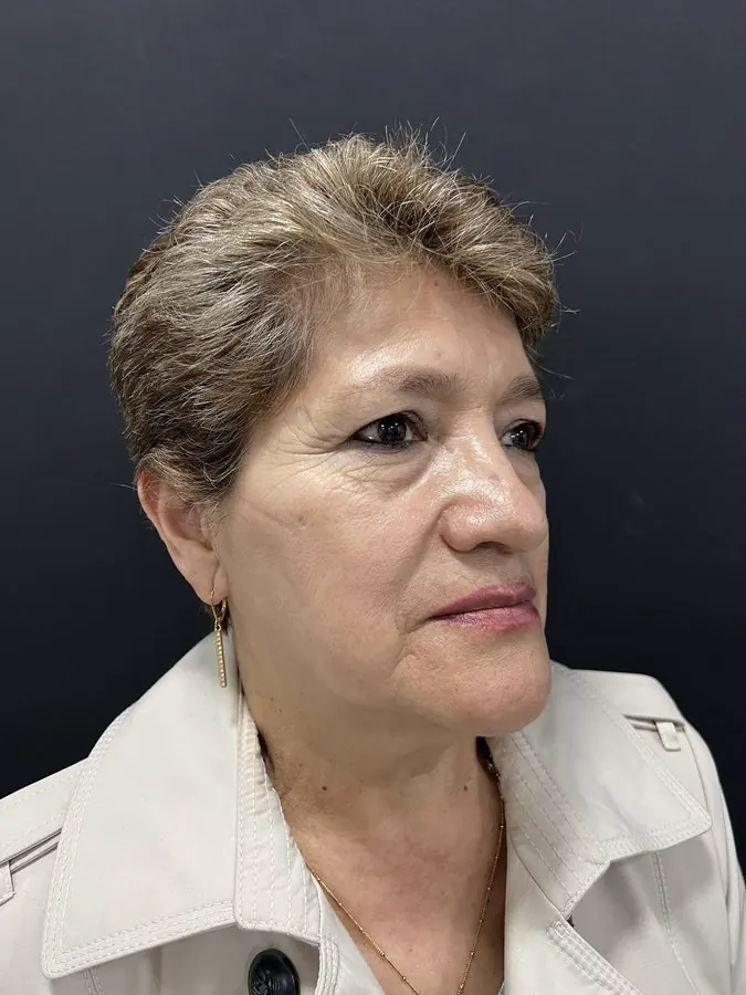 Antes de blefaroplastia con levantamiento de cejas, vista diagonal