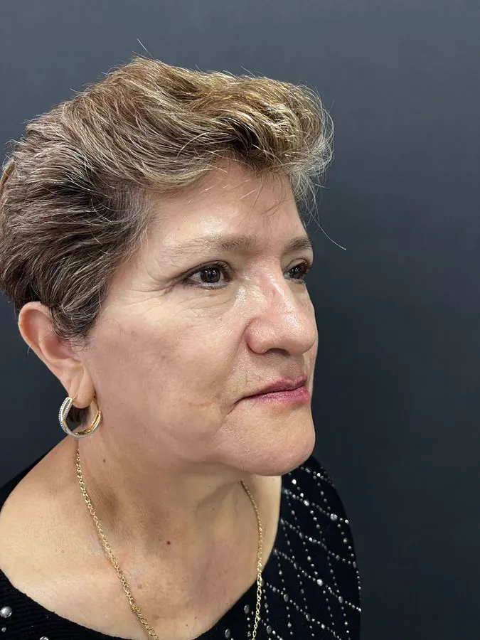 Después de blefaroplastia con levantamiento de cejas, vista diagonal