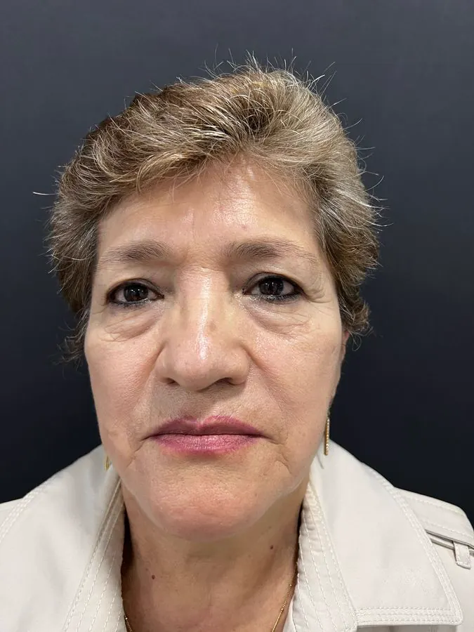 Antes de blefaroplastia con levantamiento de cejas, vista frontal