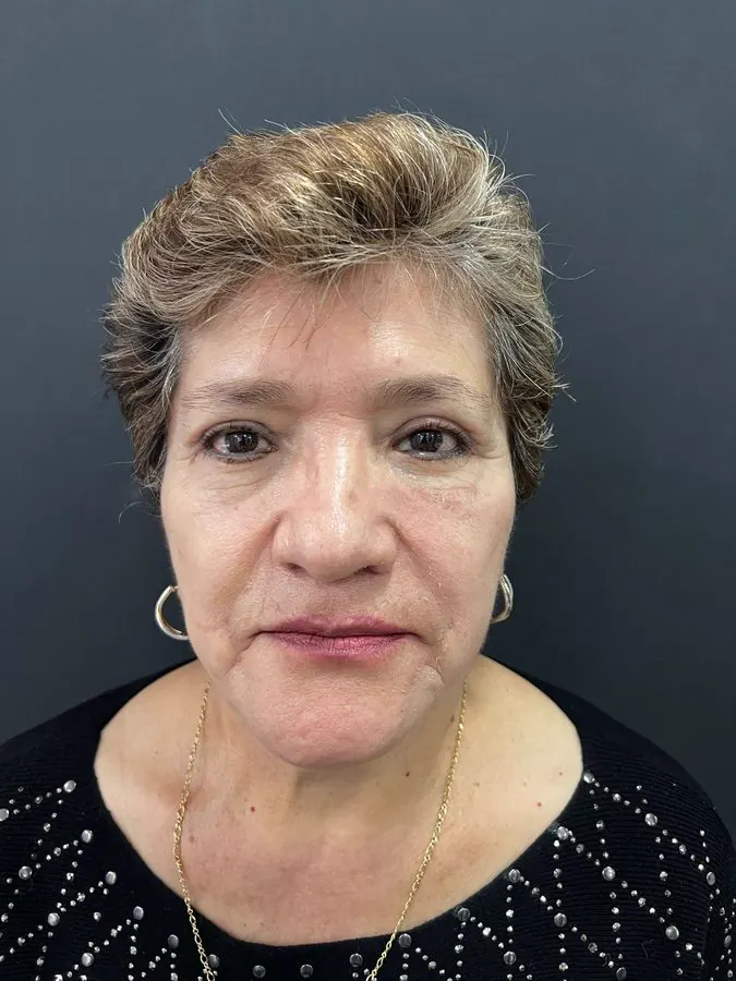 Después de blefaroplastia con levantamiento de cejas, vista frontal