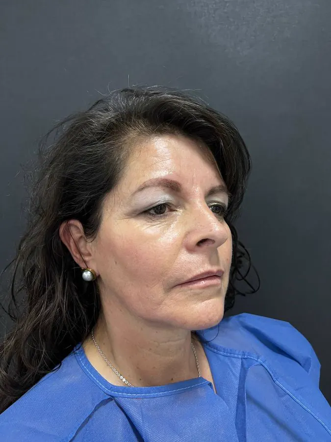 Antes de blefaroplastia y lipoinyección facial, caso 3, vista diagonal