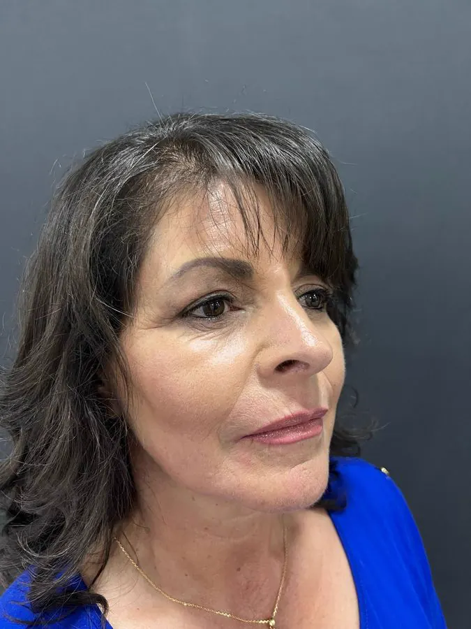 Después de blefaroplastia y lipoinyección facial, caso 3, vista diagonal