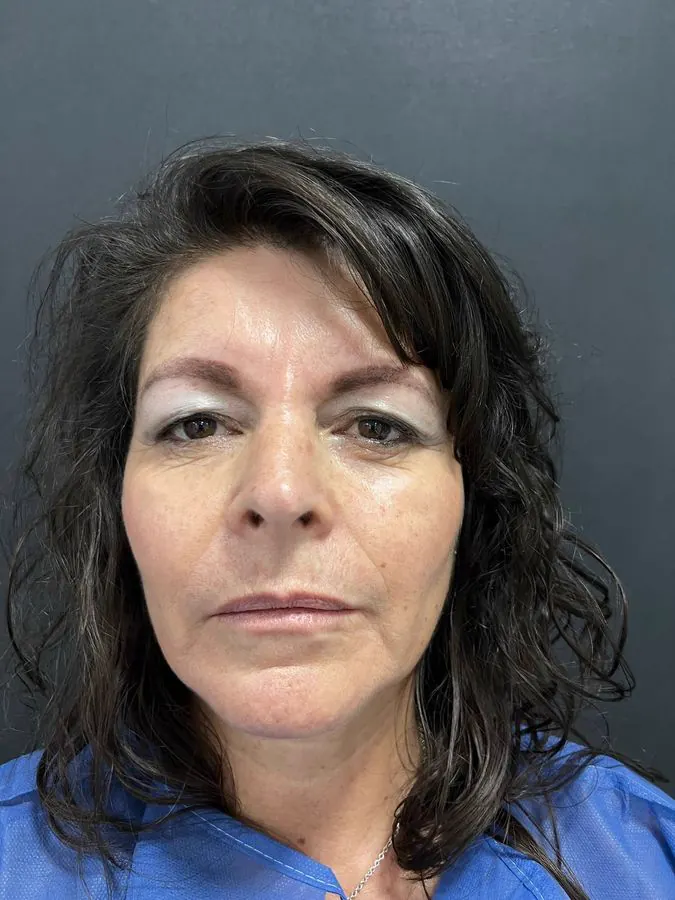 Antes de blefaroplastia y lipoinyección facial, caso 3, vista frontal