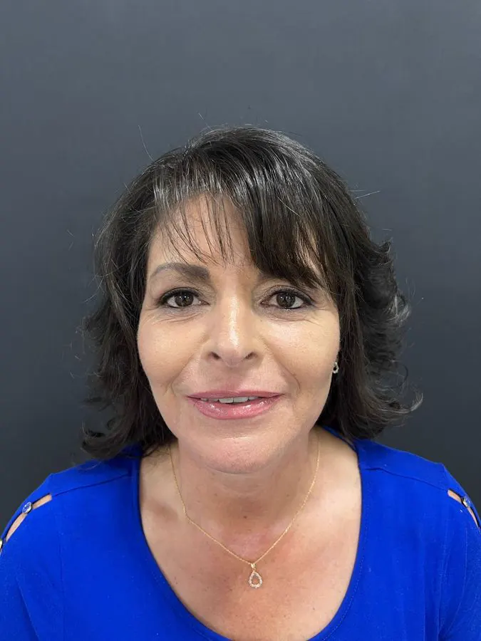 Después de blefaroplastia y lipoinyección facial, caso 3, vista frontal