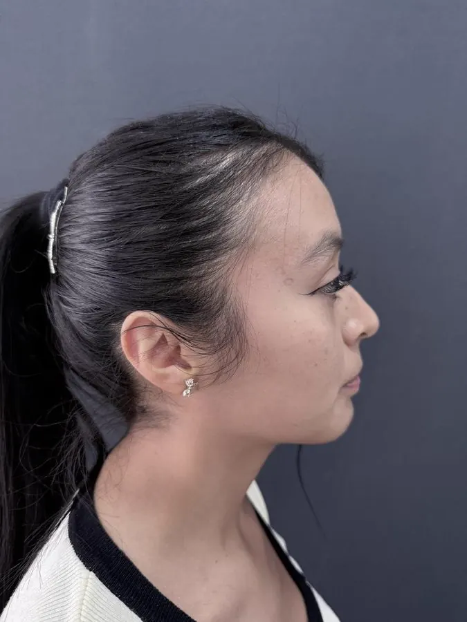 Antes de rinoplastia, paciente 1, perfil lateral