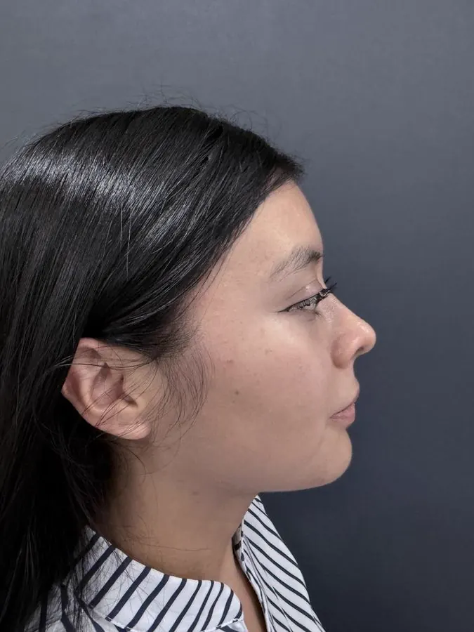 Después de rinoplastia, paciente 1, perfil lateral