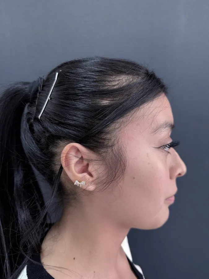 Antes de rinoplastia, paciente 2, perfil lateral