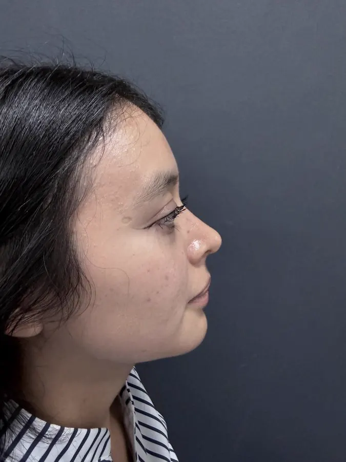 Después de rinoplastia, paciente 2, perfil lateral